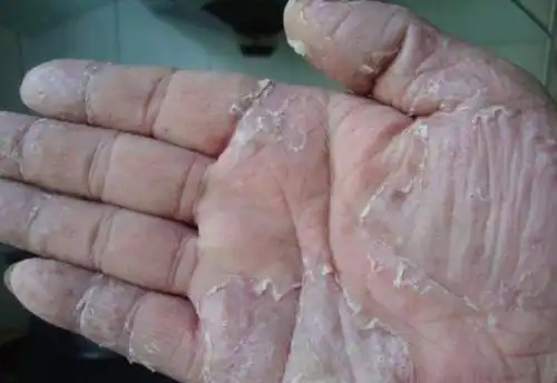 鹅掌风会自己好吗?饮食上的小窍门有妙用