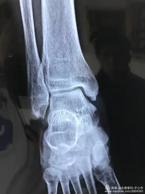 踝关节撞击症病例