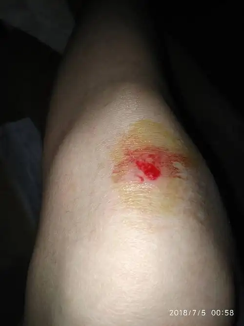 膝盖刚刚这样撞破皮了 好痛 拿棉签涂了几遍络合碘了,怎么才能快速好