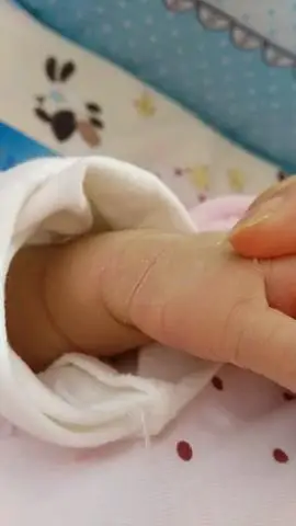 急急急,宝宝手脱皮