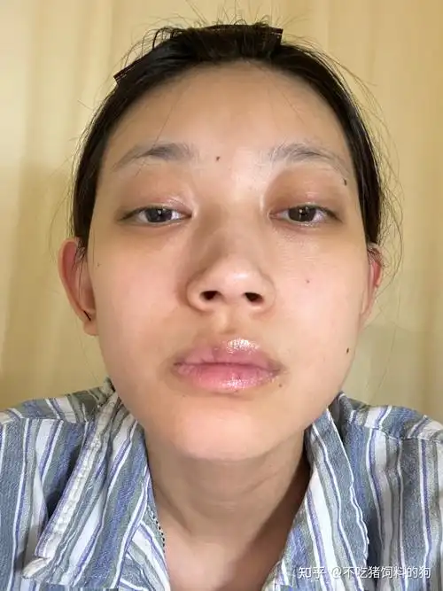 一个颞下颚关节紊乱患者的随笔 - 知乎