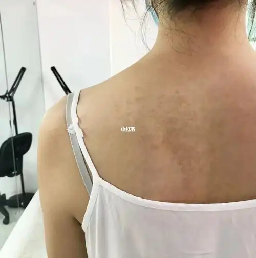 07可以用蝴蝶盖住我的胎记吗?