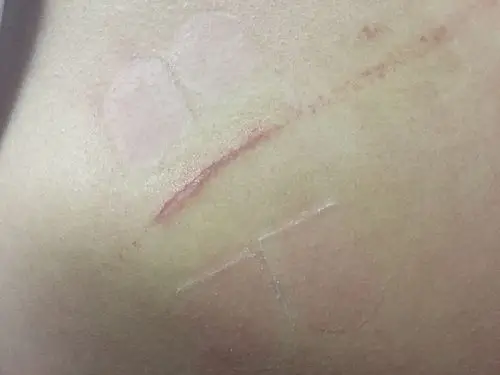 被指甲抓的流血了要不要打针啊擦了药了