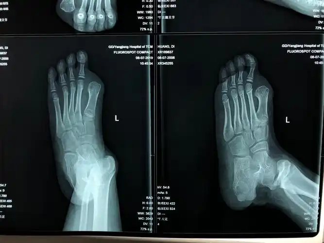 儿童踝关节损伤后畸形,该怎么处理?