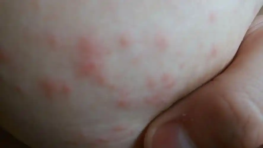 前两天开始的,只在左边胸口,很痒的红疙瘩,是什么?