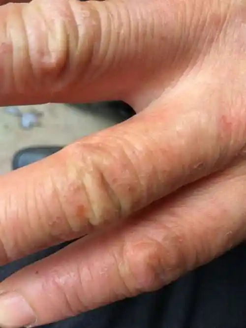 手上起小痘痘水泡,说是汗疱疹,痒,会挤出水