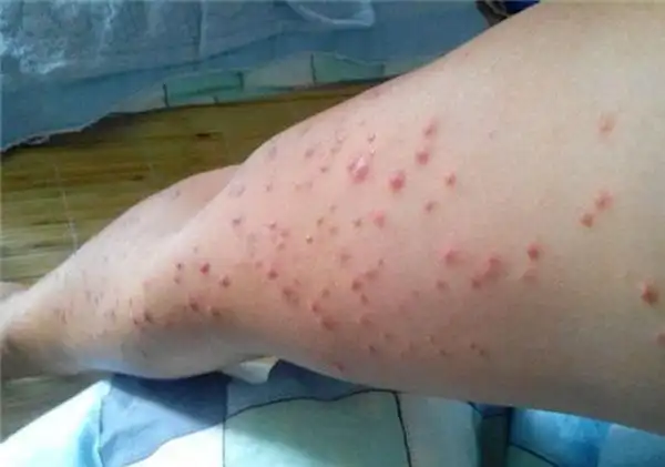 胳膊出现皮疹图片.jpg