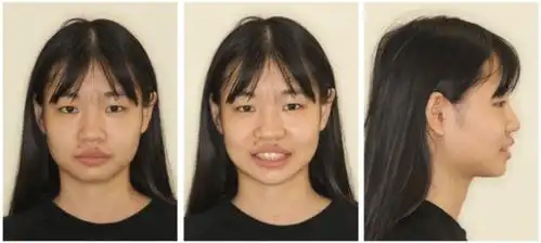 18个月消除土气龅牙女孩矫正后变身小孙怡