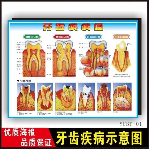 牙齿疾病图墙贴纸口腔知识贴纸牙科挂图宣传海报牙科知识宣传画