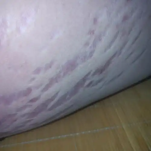 两边大腿都突然长出这东西,凹进去,肉都变软了,没感觉了,应该是死肉了