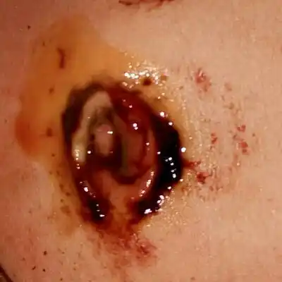 孩子出生今天十六天了,脐带刚刚才掉,肚脐这个样子正常吗?