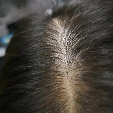 脱发严重有什么办法吗?