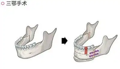 韩国id医院男士地包天凸嘴整形前后对比照片