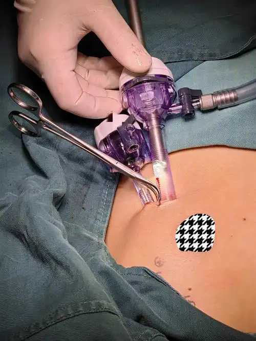 年轻女性患乳腺肿瘤无痕乳房腔镜手术解除患者困扰