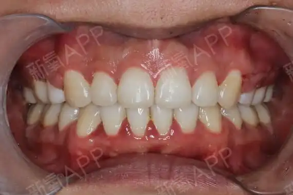 龅牙啊龅牙啊龅牙这个问题真的让我烦恼了很久大家都说我其实长得挺