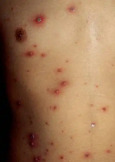水痘(varicella)_资讯_大夫e站