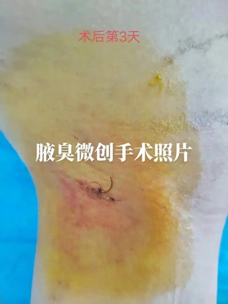 腋臭微创术后的照片 - 抖音