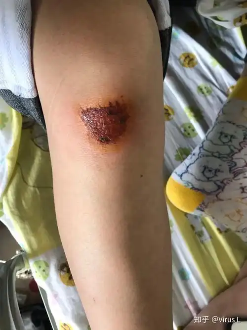 骑车侧翻膝盖摔伤破皮,怎么处理伤口,怎样才能不留疤? - 知乎