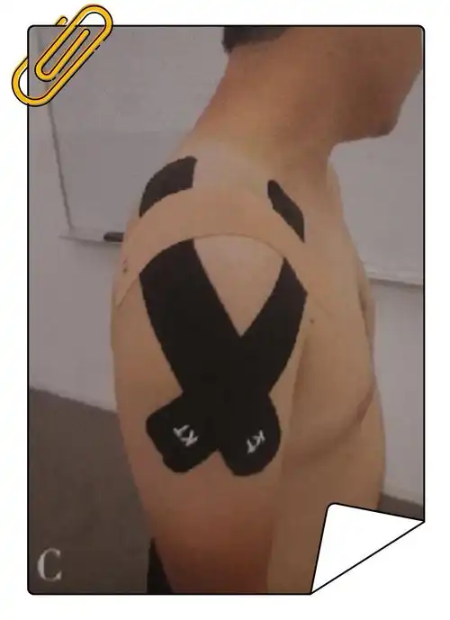 功能性贴扎技术——肩部