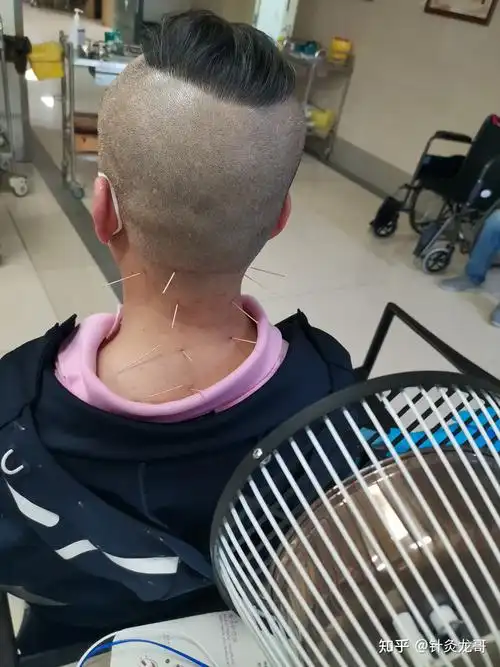 针灸是颈椎病的克星,颈椎病的针灸治疗思路你知道吗? - 知乎