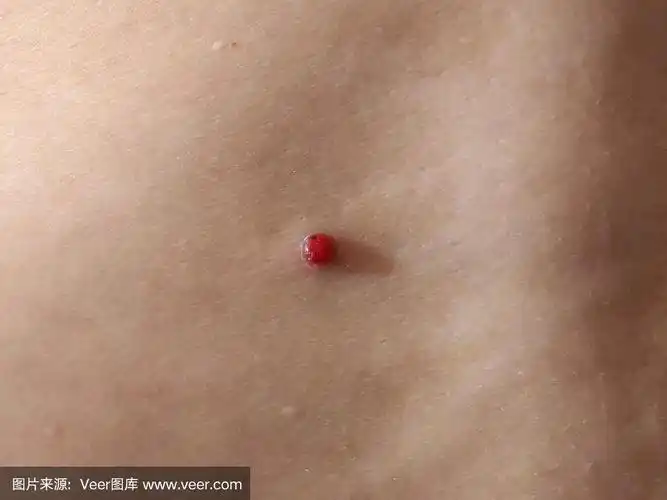 皮肤上化脓性肉芽肿