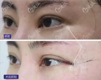 外眼角修复术前术后侧面效果图二