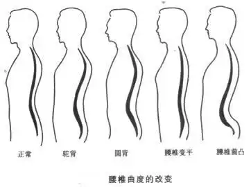 腰椎生理曲度消失时什么意思