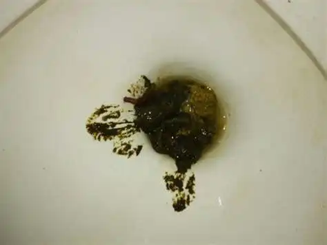 小孩大便拉出来有虫子小孩四五天不拉大便2022已更新今日图集