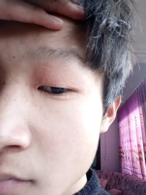 眼皮什么起皮怎么办