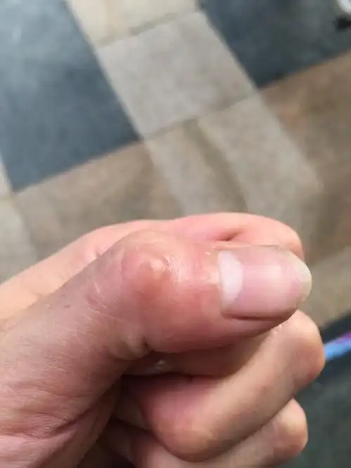 我的手指关节长了个疙瘩.表面光滑按压也不会痛.请问这是怎么回事.