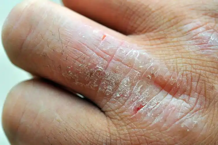 手上长癣了,脱皮,夜间有点痒,一年多了,如图,怎么办啊?什么病啊?