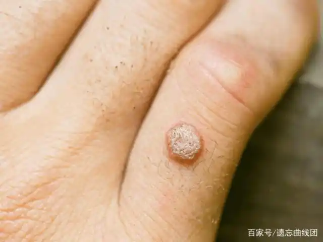 瘤子又叫瘊子,是因为真菌感染导致的一钟皮肤增生,虽然不痛不痒,但是