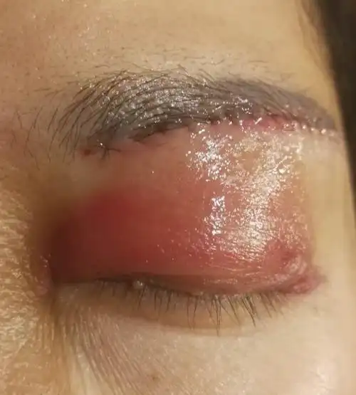 婕斯精华素对切眉术后的创面恢复