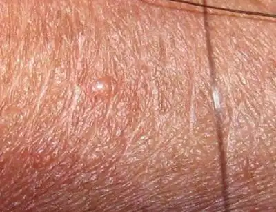 包皮小疙瘩图片7