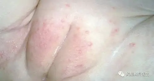 妈妈们的担心:尿布疹该如何诊断?-聂顺利主治医师-爱问医生