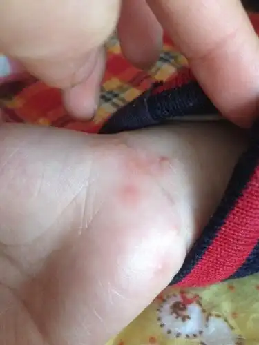 三岁小孩手上起疥疮怎样才能治疗好,求答,谢谢你们咯_百度宝宝知道