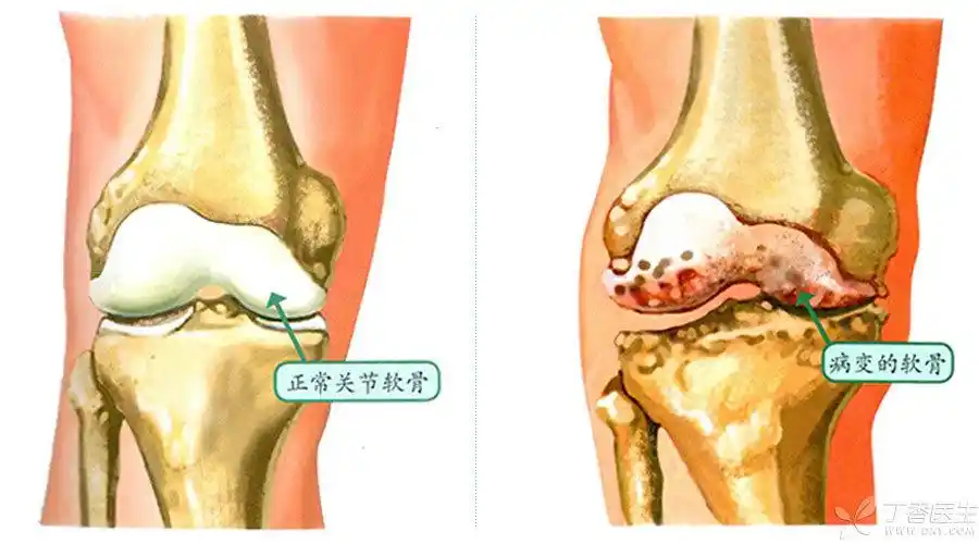 膝关节本身就是全身负重关节,其表面有一层软骨,就如同给膝关节的骨质
