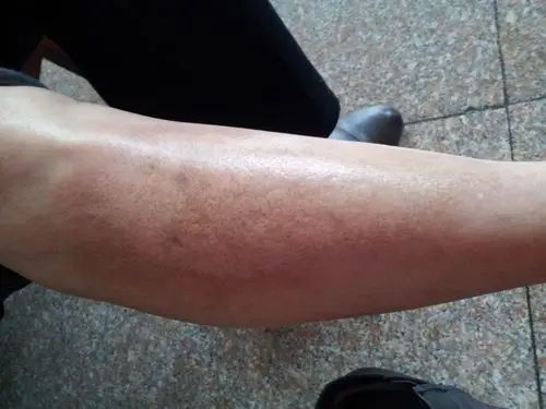 展开全部 局灶性硬皮病几乎不发展为系统性硬化症,但某些系统性硬化