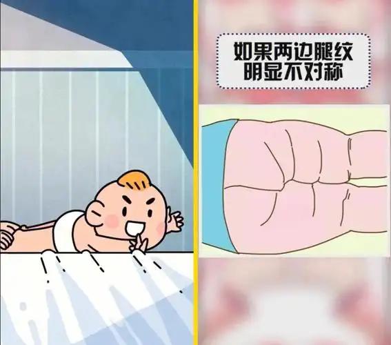 让宝宝趴在床上,将双腿轻轻拉直,看腿纹的数量和位置是否有明显不对称