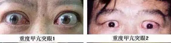 白血病晚期出现眼部转移也会引起眼睛突出