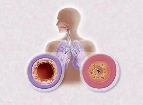 引起慢性支气管炎的原因有哪些?常用治疗药物有哪些?_手机搜狐网