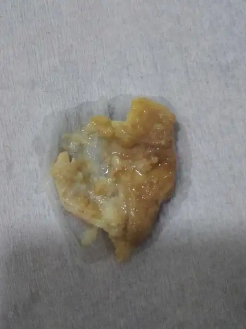 有没有妇科炎症治愈的?