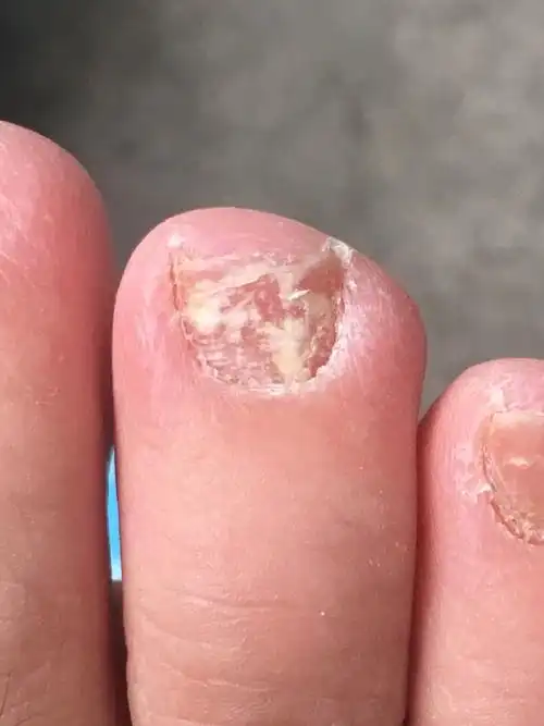 男的脚趾甲上面有白色的东西,还有轻度脚气?怎么能弄好啊?