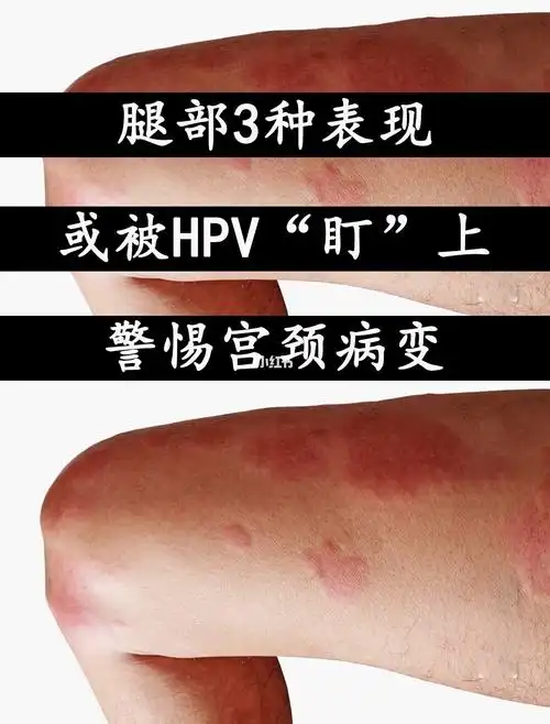 腿部3种表现或被hpv盯上