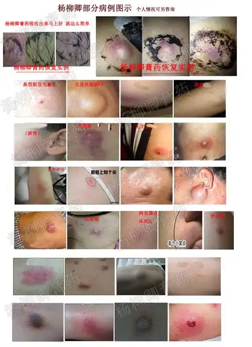 【毛囊清疮贴】毛囊y炎粉-瘤皮脂腺囊-肿脂肪-瘤富贵包十贴杨柳卿