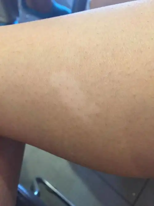 小腿内侧皮肤有一块白色的斑 长了十几年了 这是不是有得白癜风的前兆