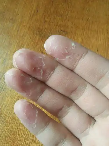 手指老是脱皮,一个多月,不停的脱,这是为什么,怎么解决啊?
