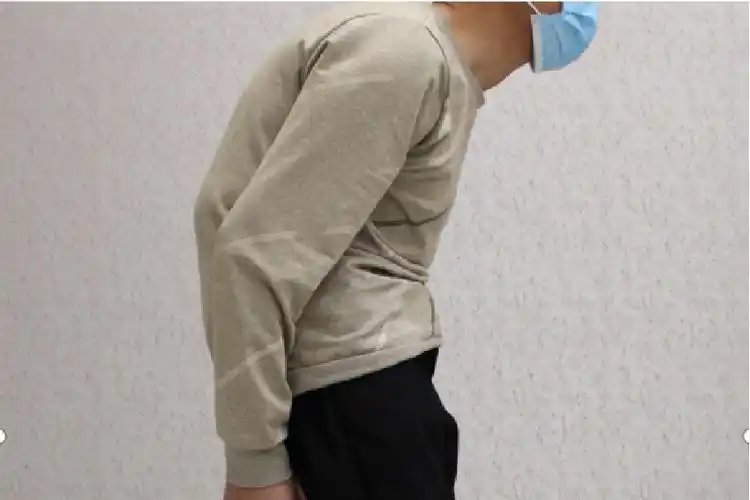 胸椎严重后凸图