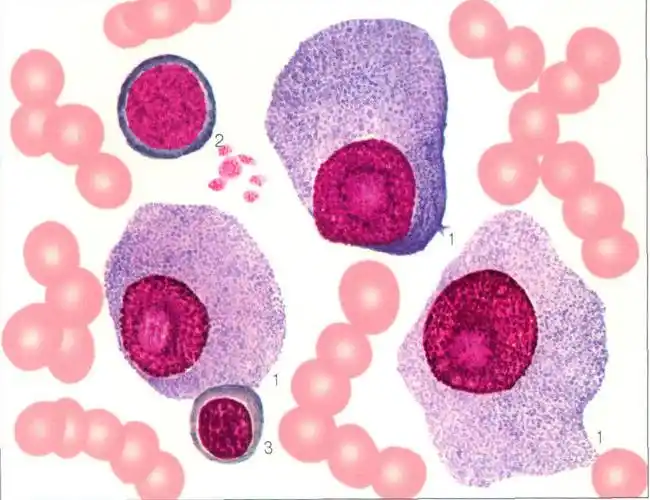 (图) 多发性骨髓瘤(网状细胞型)骨髓象(集中视野)