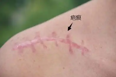 手术刀口长好图